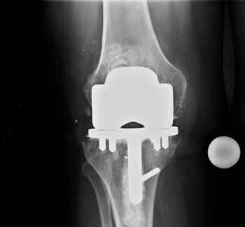 artoplastica del ginocchio.jpg