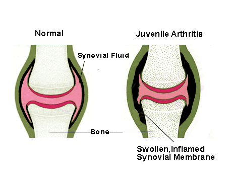 artrite giovanile 21.gif