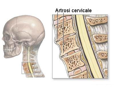 artrosi cervicale.jpg
