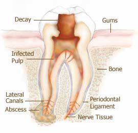 Ascesso dentale: cause, sintomi, cure e complicazioni