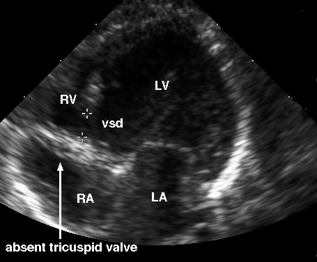 atrisia della tricuspide.gif