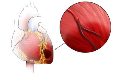 attacco di cuore3.jpg