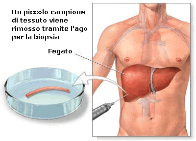 biopsia epatica.gif