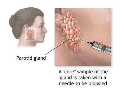 biopsia parotide.jpg