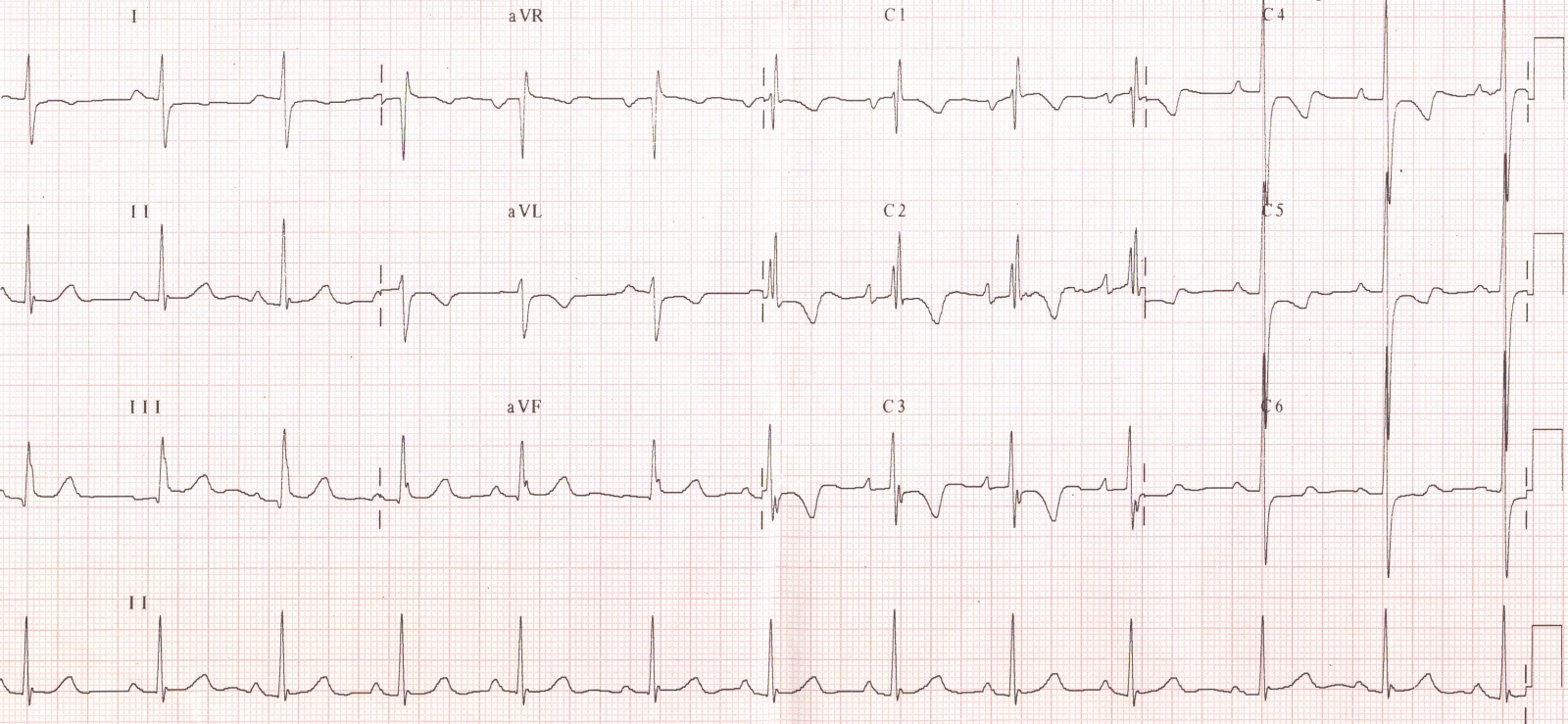 branca ecg.jpg