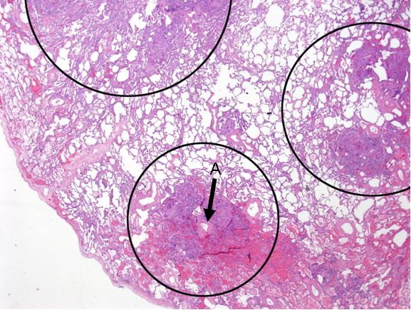 bronchiolite21.jpg