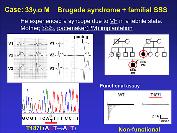 brugada sindrome1.jpg