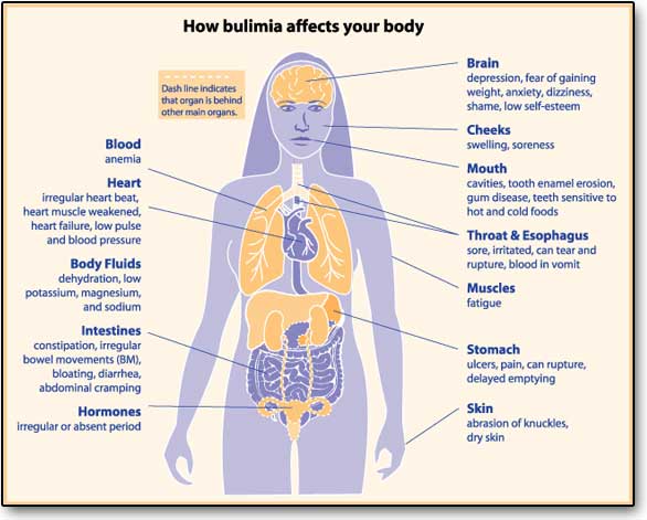 Bulimia nervosa: rimedi e sintomi di un problema grave