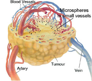 Cancro del fegato : sintomi, cause, cure e prevenzione
