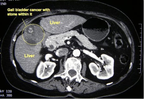 cancro cistifellea esame raggi X.jpg