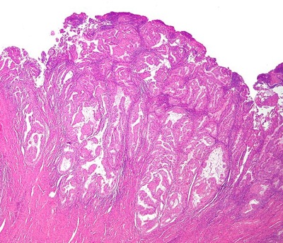 Carcinoma dell'endometrio : sintomi, cause, cure e prevenzione