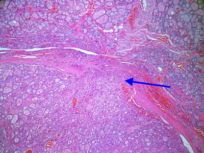 carcinoma a cellule di Hurtle.jpg