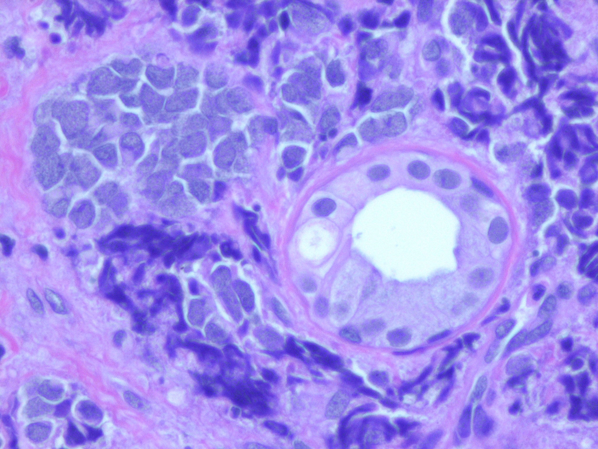 carcinoma cellule di Merkel21.jpg