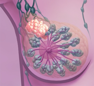 carcinoma infiammatorio1.jpg