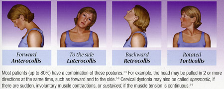 cervical_dystonia.jpg
