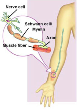 charcot-Narie-Tooth21.jpg