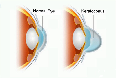 Cheratocono : sintomi, cause, diagnosi e cure