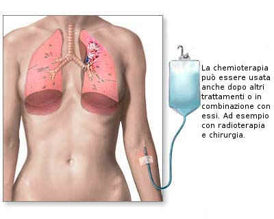 Chemioterapia