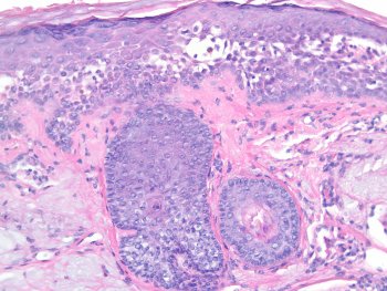 Cheratosi attinica : sintomi, segni, cause e cure