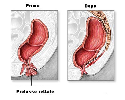 chirurgia del prolasso rettale.jpg