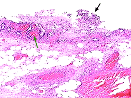 colite ischemica21.gif