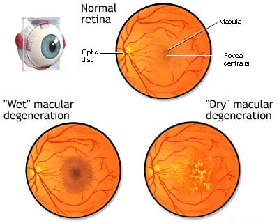 degenerazione maculare secca-esempio.jpg