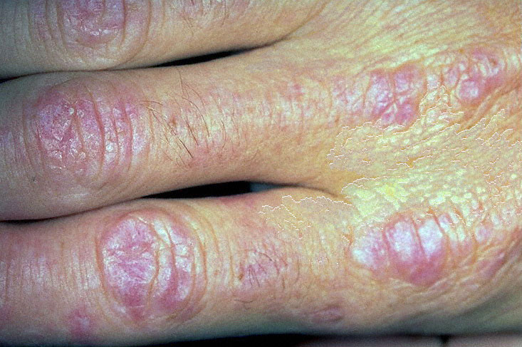 dermatomiosite.jpg