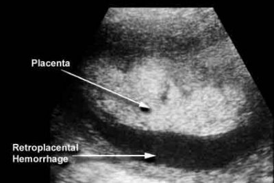 Distacco della placenta : cause, sintomi e prevenzione