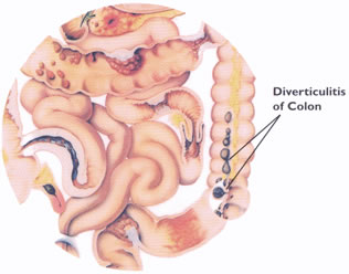 Diverticolite: informazioni e terapie