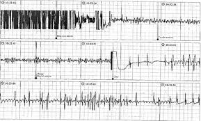 ecg vaso vagale.jpeg