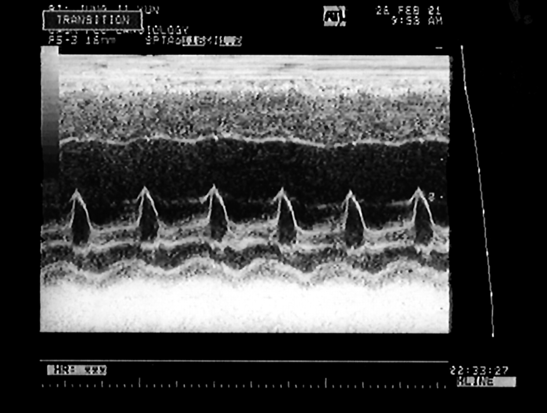 Cardiomiopatia dilatativa