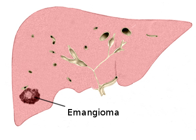 Emangioma epatico : sintomi, cause, complicazioni e diagnosi