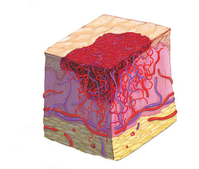 Emangioma : sintomi, cause, diagnosi e cure