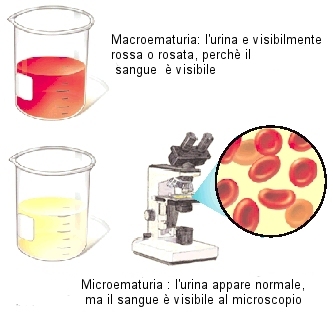 ematuria2.jpg