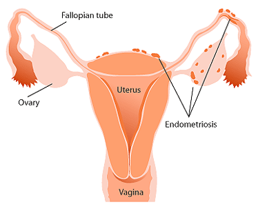 endometriosi1.gif