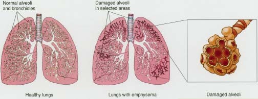 enfisema.jpg