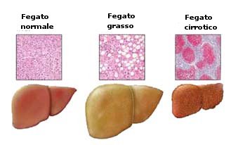 Epatite alcolica : sintomi, cause, diagnosi e cure