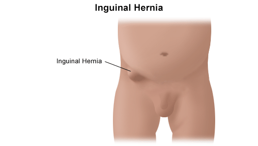 Ernia inguinale: sintomi e rimedi