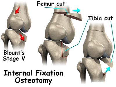 esempio di osteotomia del ginocchio.jpg