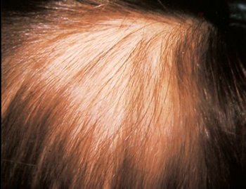 Tricotillomania : cause, cure e psicoterapia