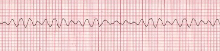 fibrillazione ventricolare.jpg