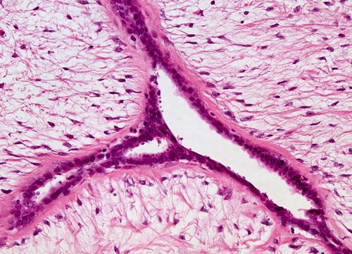 fibroadenoma1.jpg