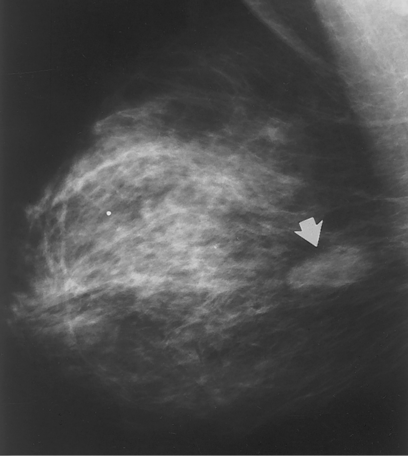 fibroadenoma21.jpg