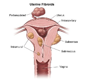 fibromi uterini.jpeg