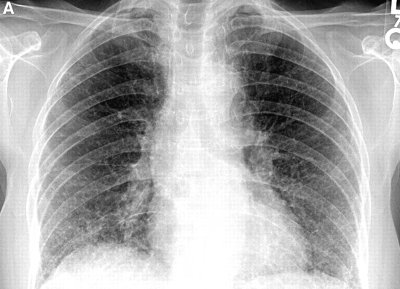 fibrosi polmonare.jpeg