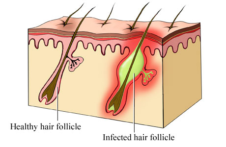 follicolite.jpg