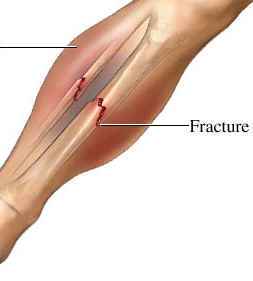 frattura da stress 1.jpg
