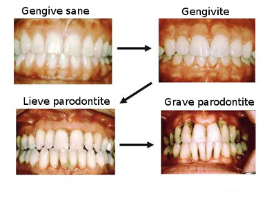 gengivite0.jpg