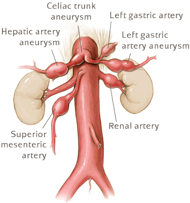 displasia fibromuscolare
