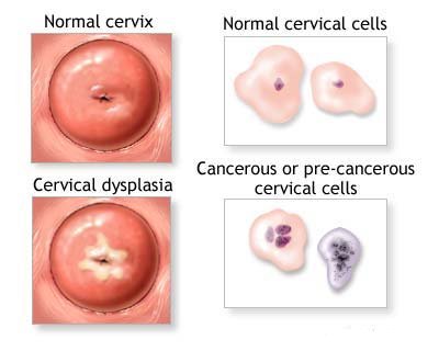 Pap test : procedura, informazioni e vantaggi